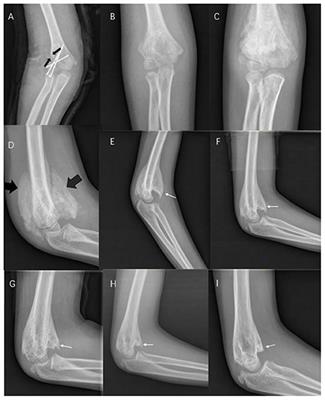 Case Report: Unusual Presentation of Myositis Ossificans of the Elbow in a Child Who Underwent Excessive Postoperative Rehabilitation Exercise